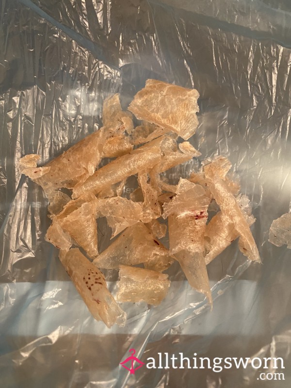 Bag Of P**led Off Psoriasis Skin.