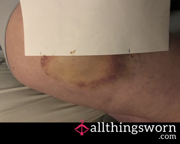 Biggest Bruise On My Thigh - Changing Colour, Changing Shape