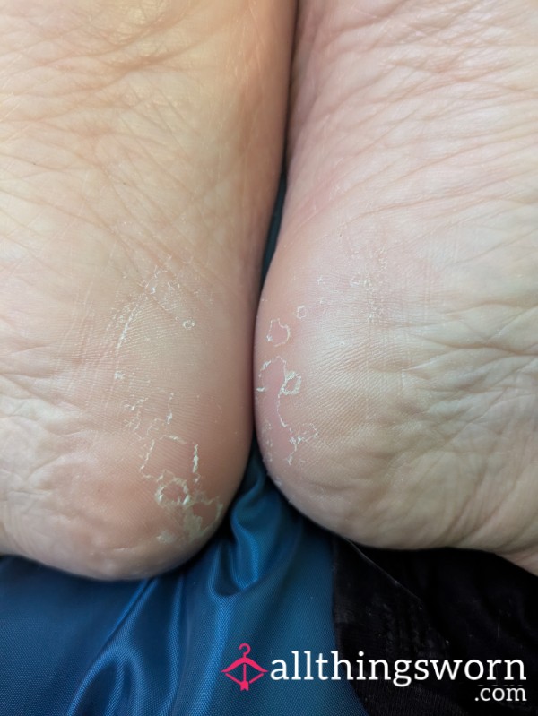 Boots Ruined My Feet
