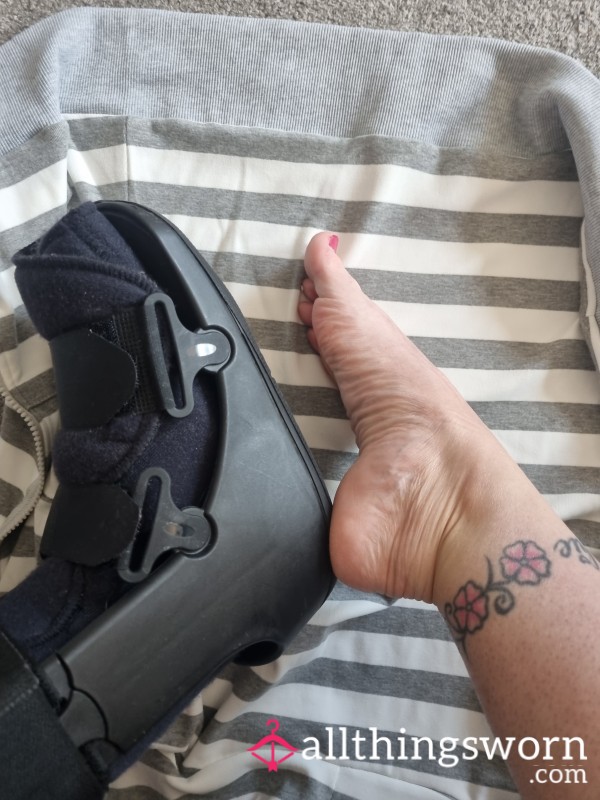Broken Ankle/foot Sweaty And Smelly