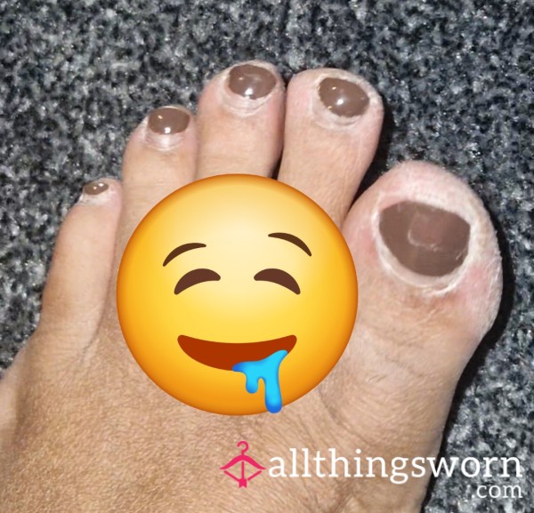 Close Up Of My Dry Crusty Feet!!