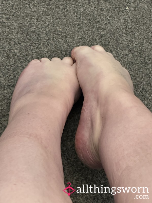 Crusty Feet