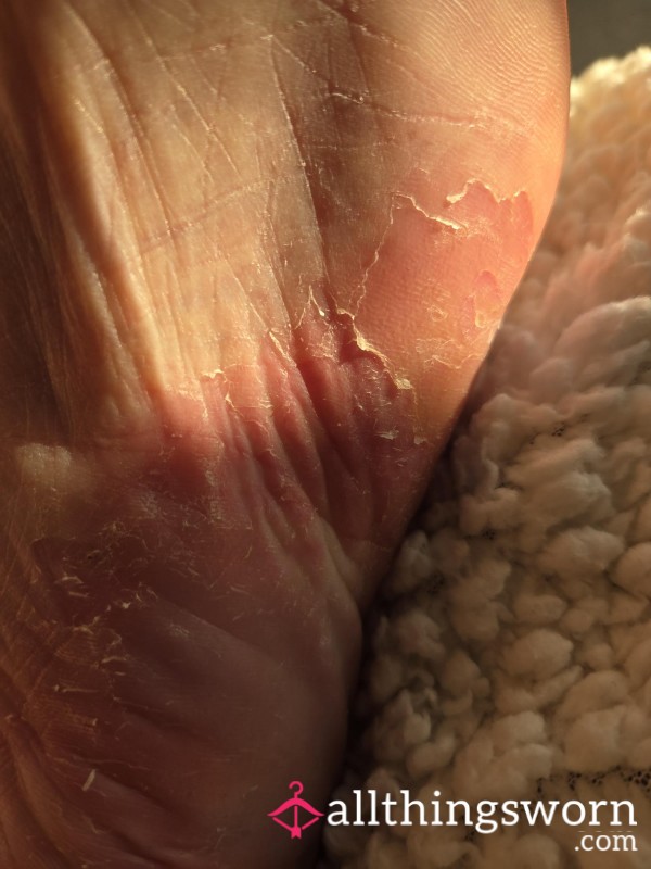Crusty Feet And All Things Sweet!