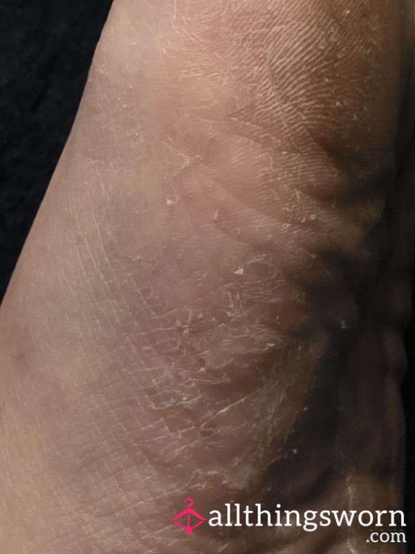 Crusty.feet