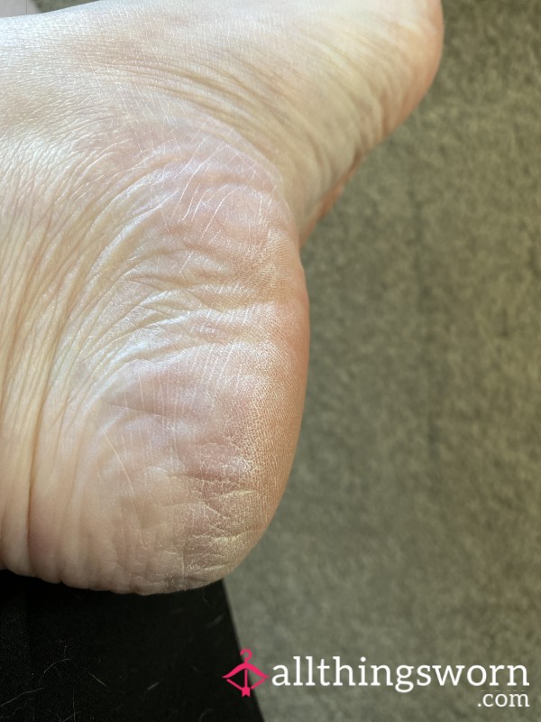 Dry Cracked Heels