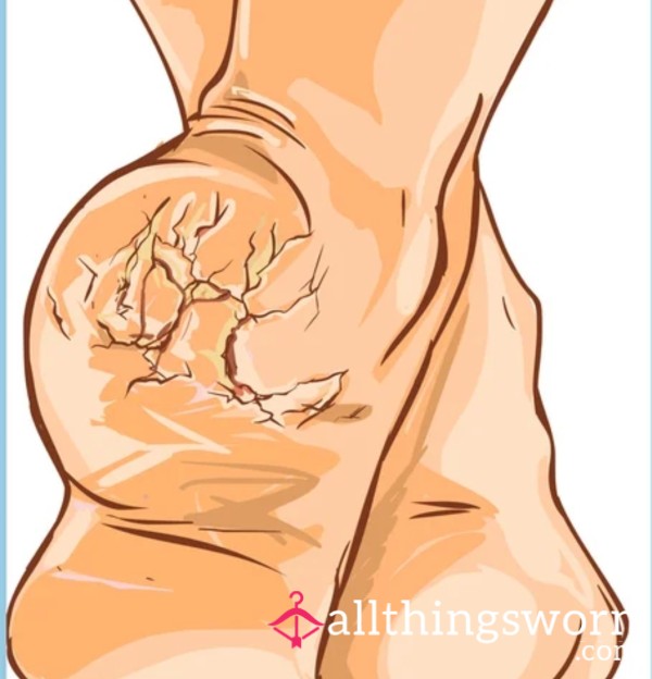 Dry, Crusty, Chubby Feet Ignore Video