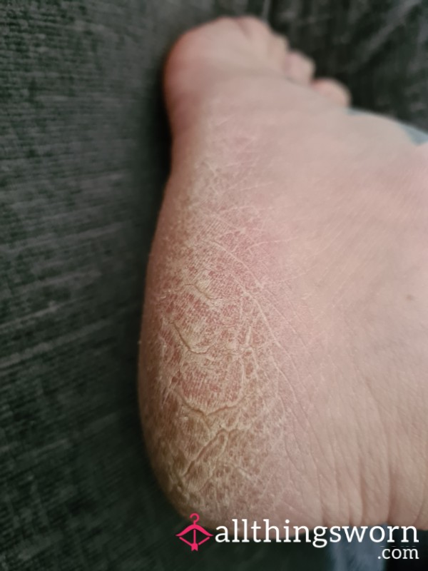 Dry Crusty Feet