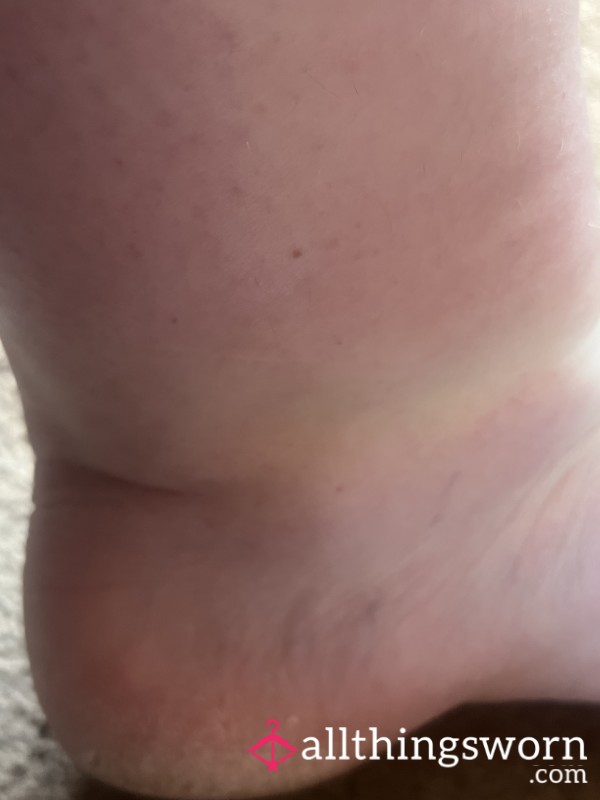 Dry Heels And Cankles