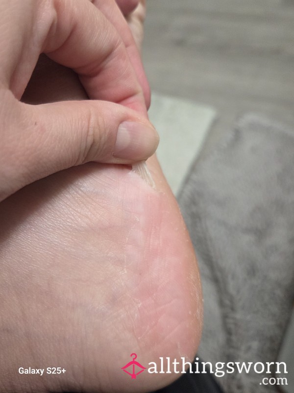 Feet Dead Skin From P**ling Mask