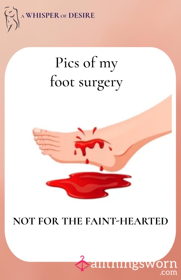 Feet Pics - Photos Of My Foot Surgery - Not For The Faint-hearted!