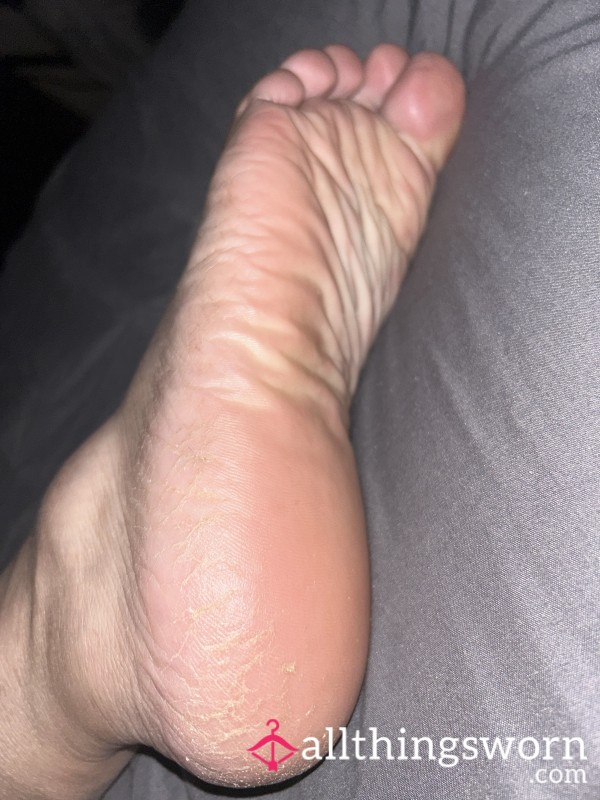 Flat Foot