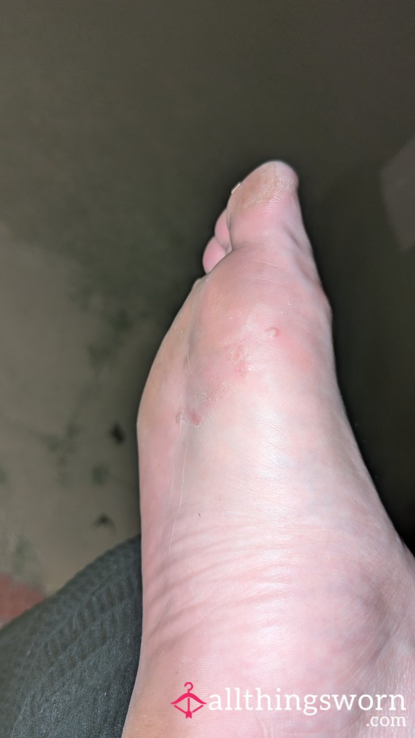 Foot Exfoliation Shedding 1 Foot