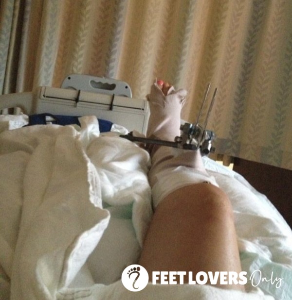 Foot/ankle/leg Injury Photos