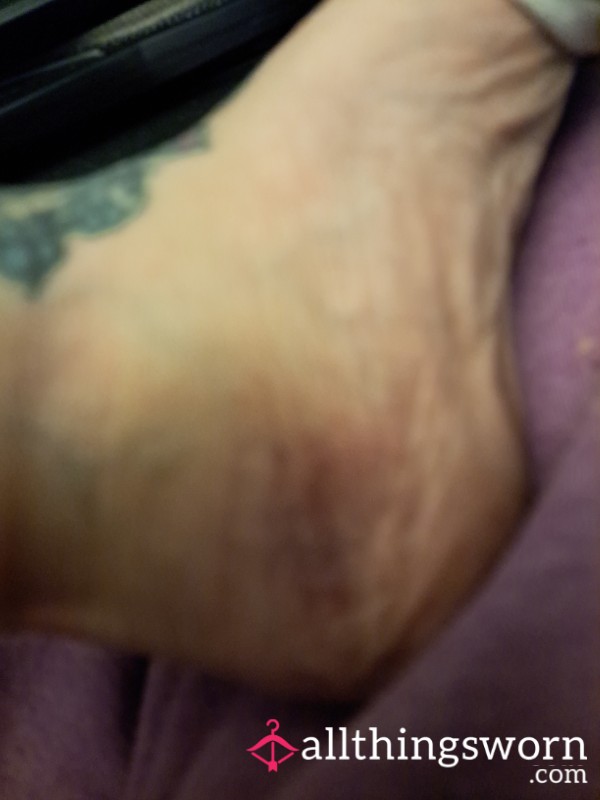 Fractured Ankle For The Curious
