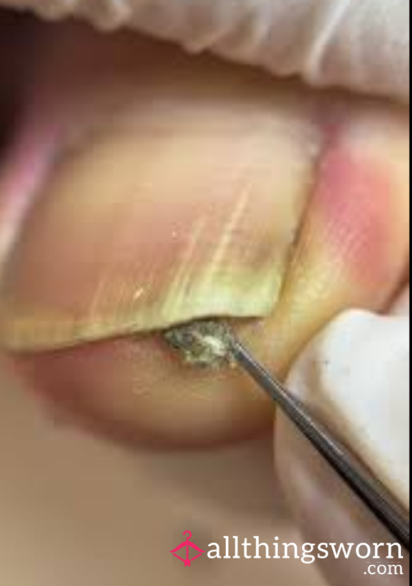 I Have Always Got Thick Smelly, Actually Repulsive Toe Gunk Jam...want It?