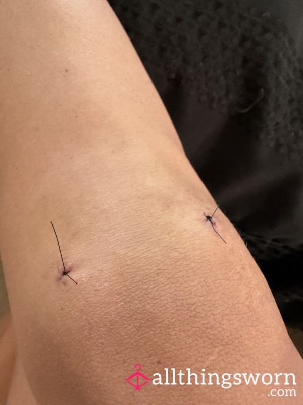 Knee Surgery Stitches