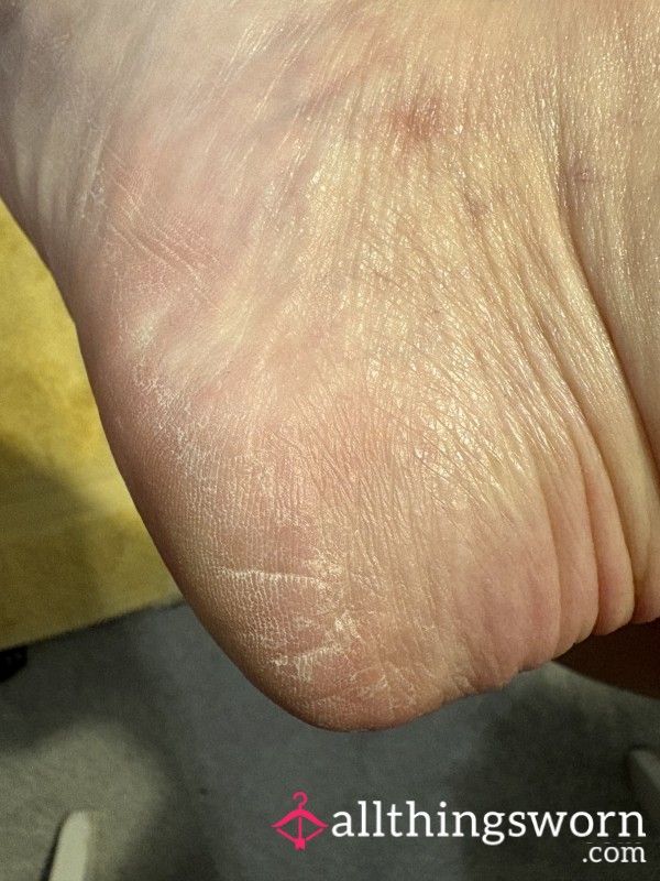 My Dry Crusty Feet