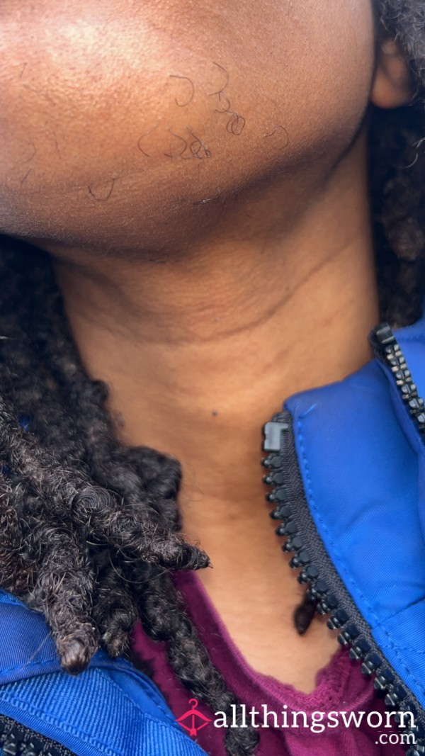 My Long Ingrown Chin Hairs