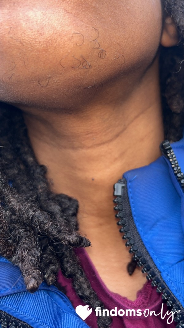 My Long Ingrown Chin Hairs