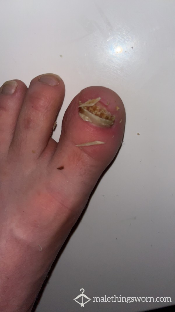 Old Picture Fully Grown Back Now, Ingrowing Toe Nail