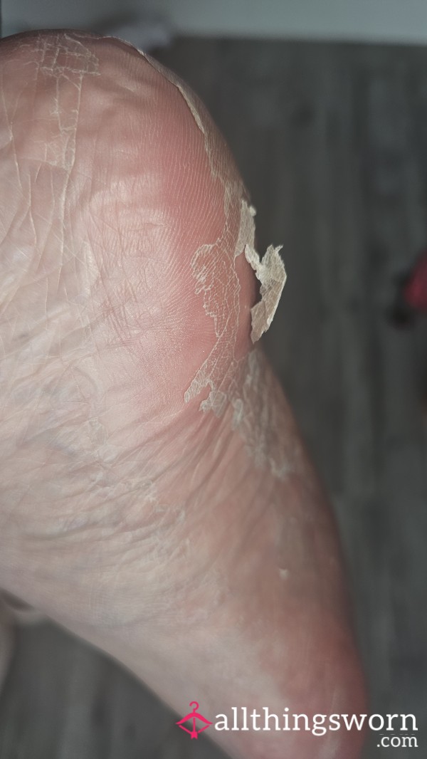 P**ling The Skin Off My Foot After A Footmask 😌