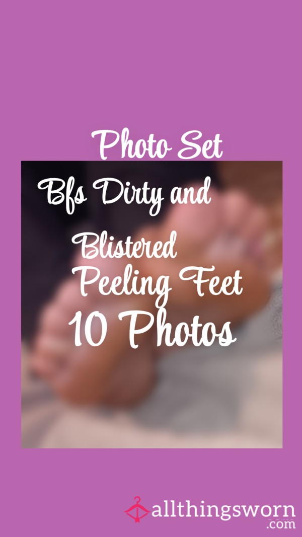 Photo Set| Bfs Dirty, Blistered And P**ling Feet Pics| 10 Photos