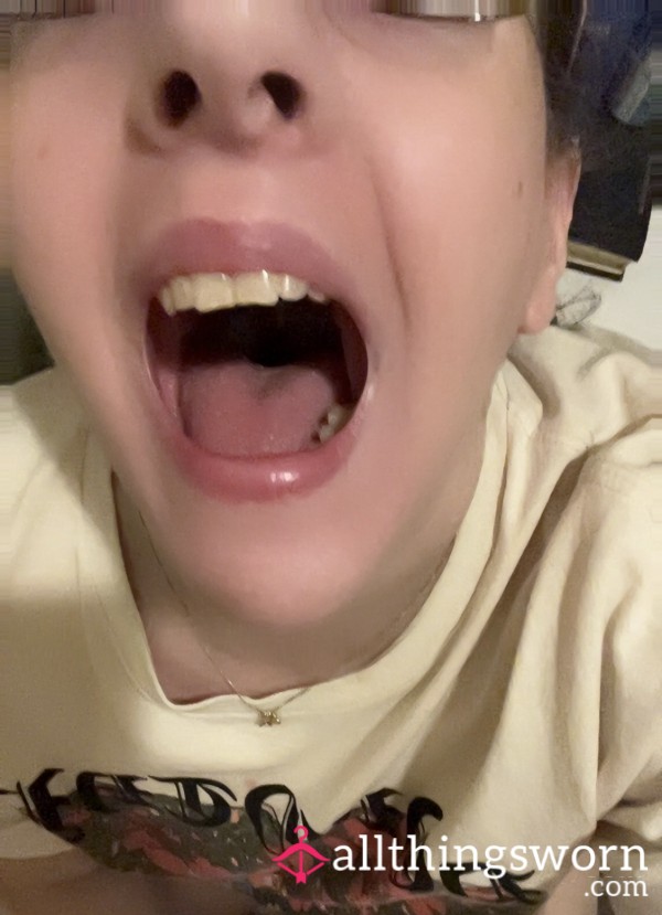 9 Pics Of My Tonsil Removal (scabs)(kinda Graphic/gnarly)