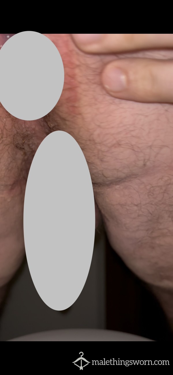 Playing With Hemorrhoids