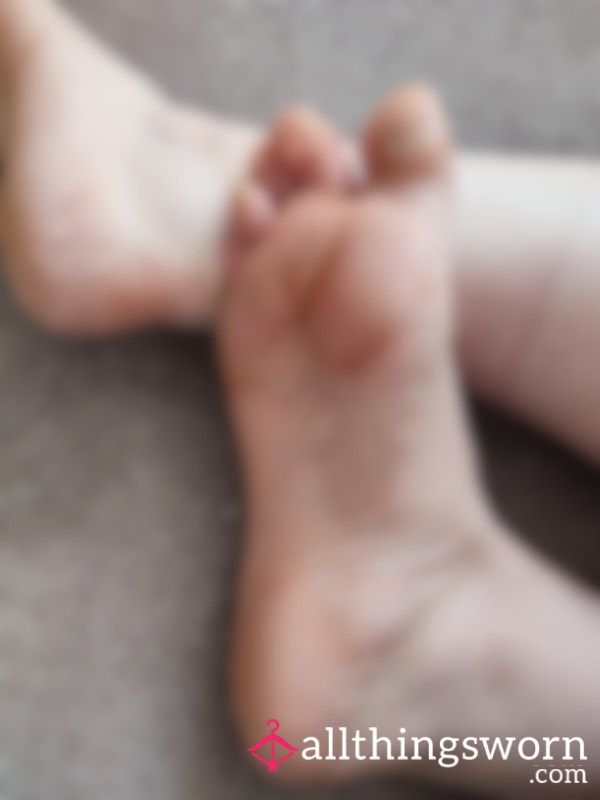 Raw Foot Close-Up — Healing Blistered Toe, P**ling Skin, Full Detail With Sole