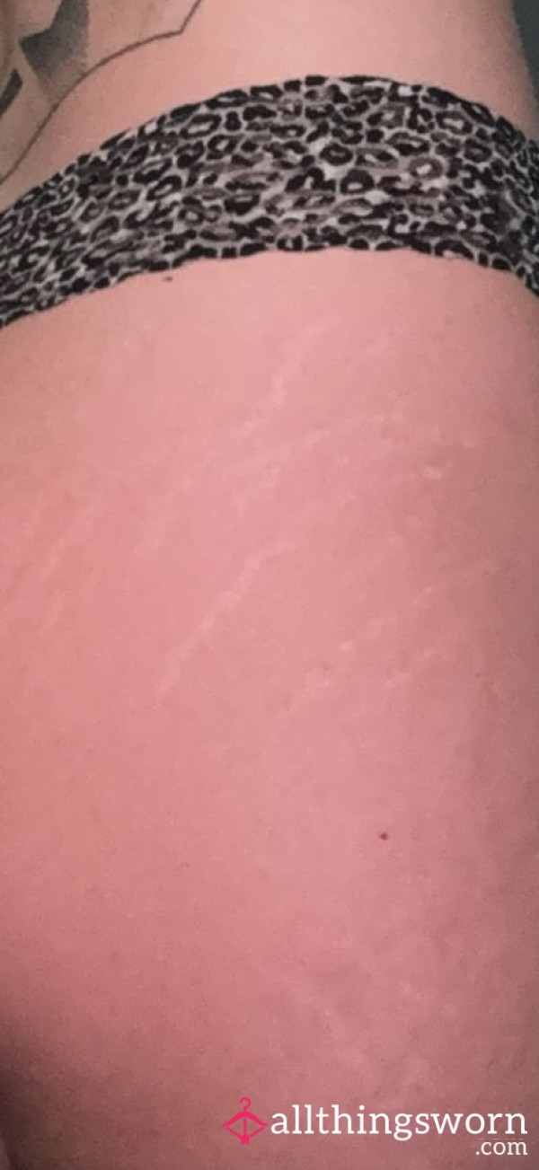 Sunburn 🥵