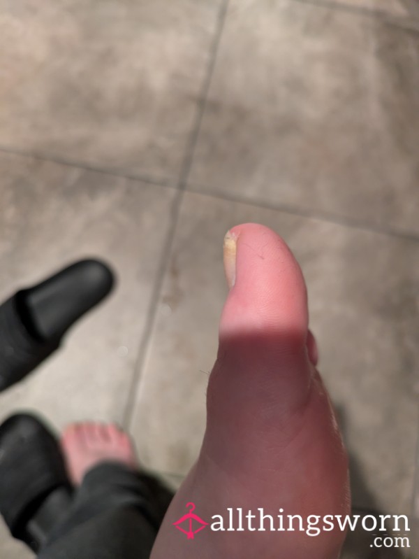 Ugly Feet Jacked Up Toenails