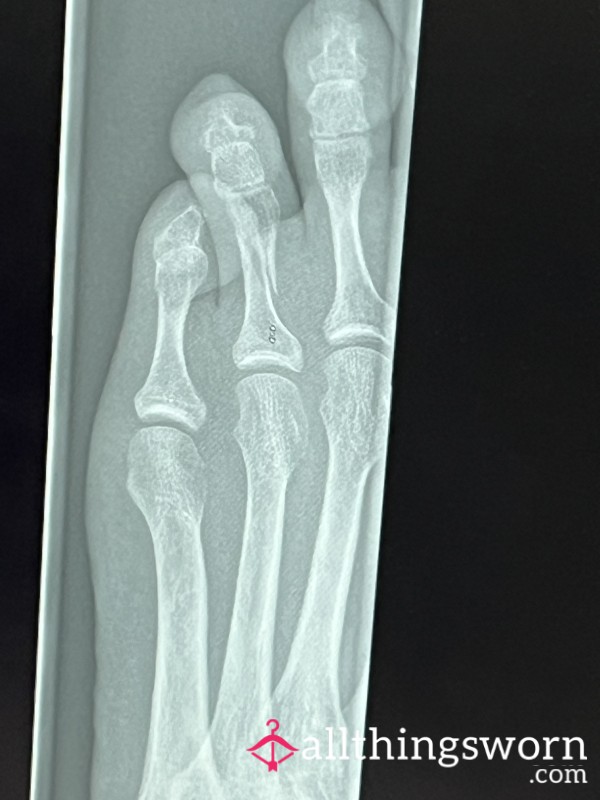 Want To See My Broken Toe?! 8x Photos